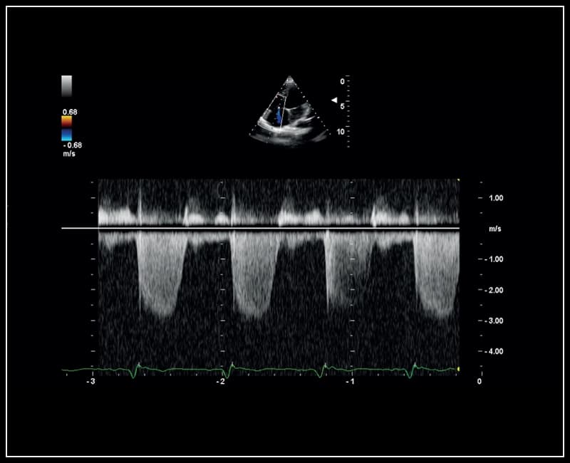 Регургитация трехстворчатого клапана в режиме постоянно-волнового доплера