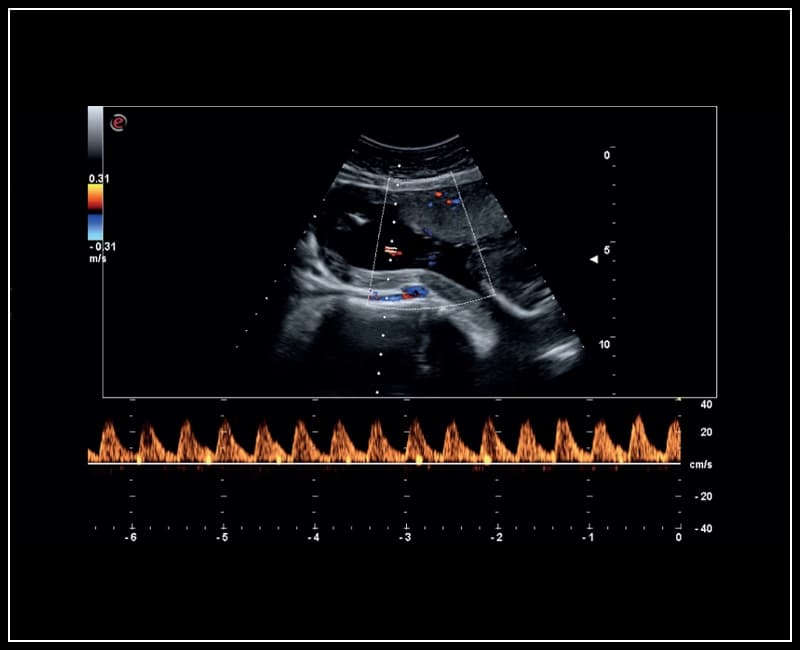 Пуповина в режиме энергетического доплера