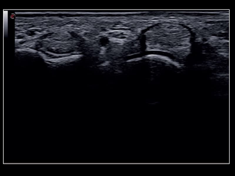 Поверхностные сухожилия – высокочастотное исследование до 24 МГц 