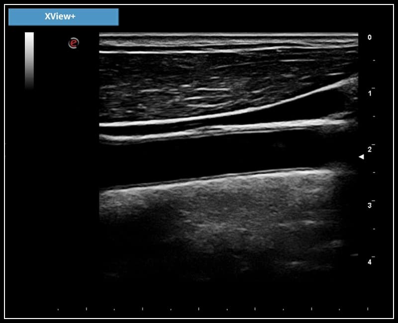 Алгоритм уменьшения спекл-шумов в режиме реального времени – XView