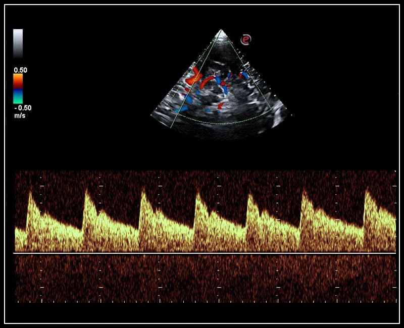 Исследование средней мозговой артерии в режиме энергетического доплера