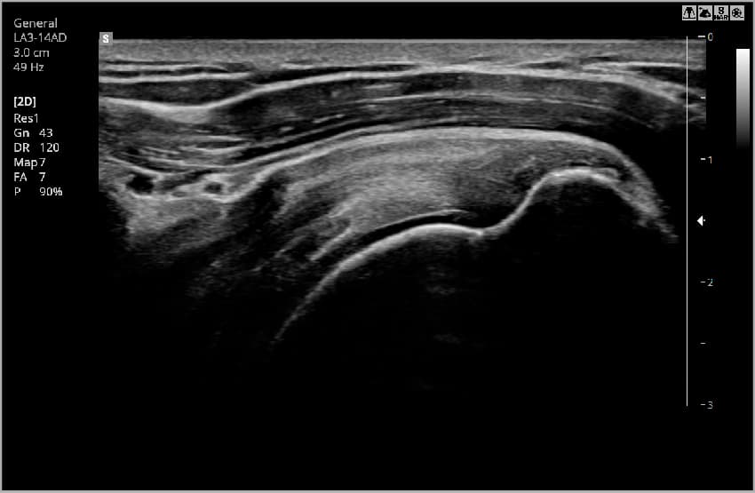 Плечевой сустав – B-режим 