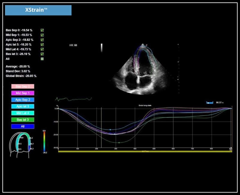 Анализ глобальной деформации левого желудочка – XStrain 