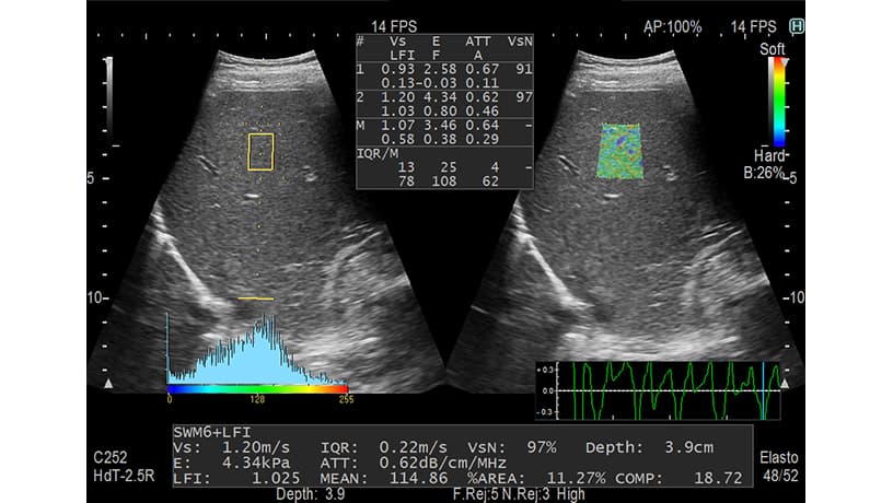 Elastography