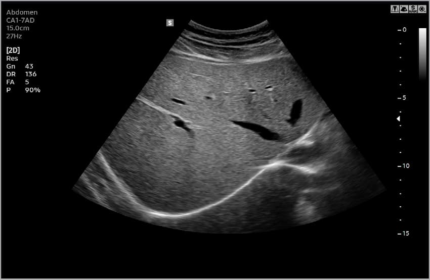 Печень – B-режим 