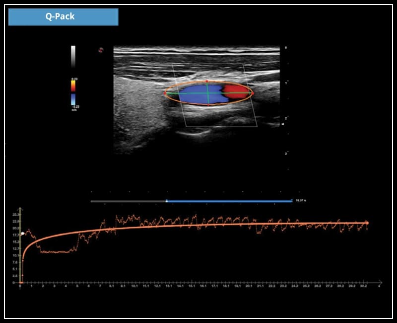 Мультимодальный инструмент для количественного анализа кривых контрастной перфузии – Q-Pack