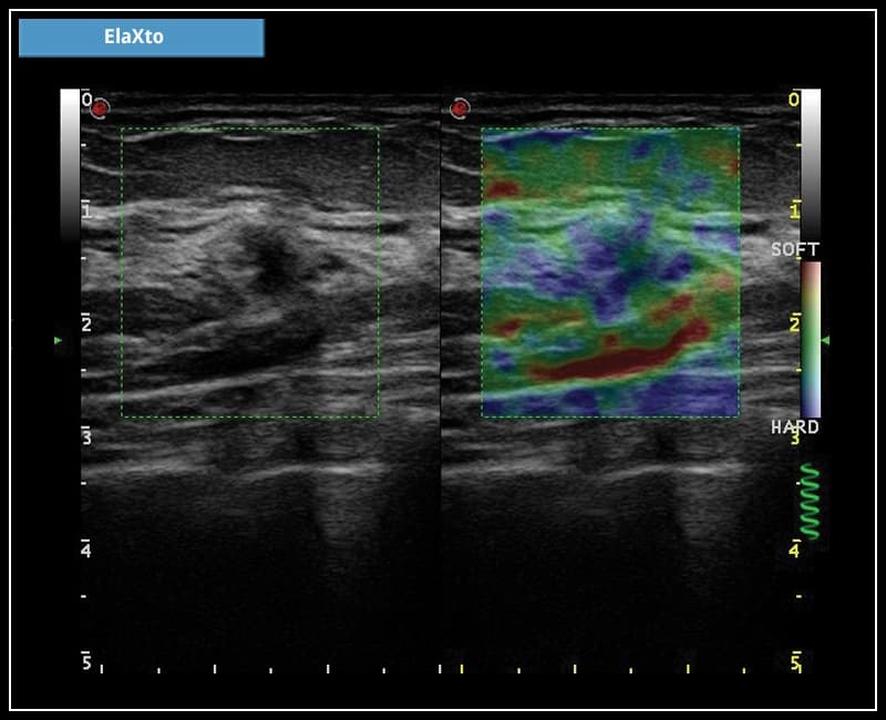 Оценка эластичности тканей – ElaXto