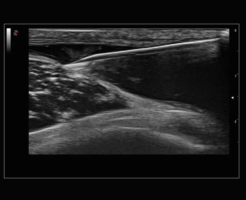 Визуализация иглы