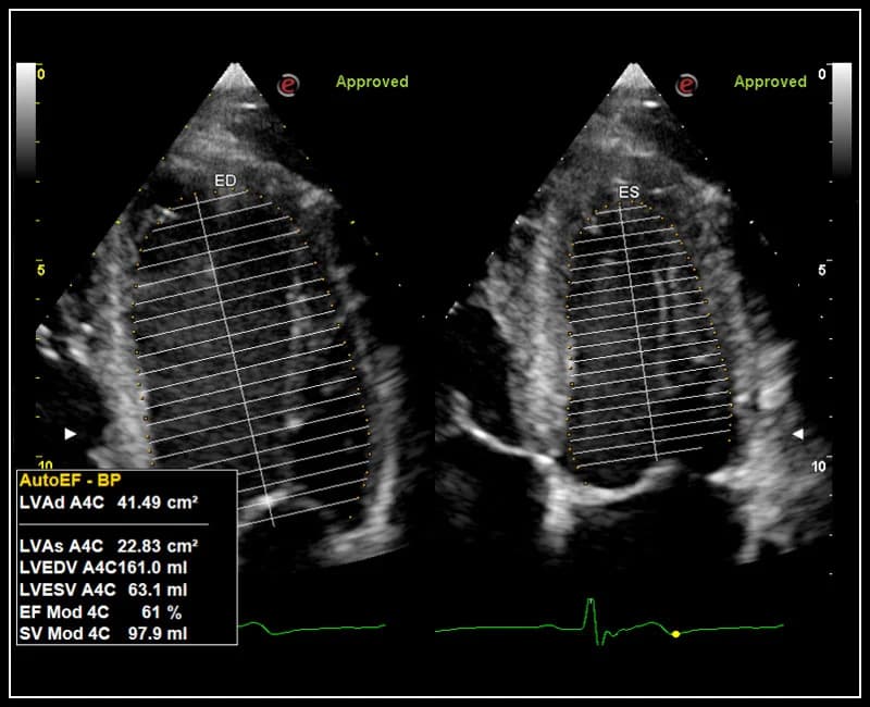 Автоматизированное измерение фракции выброса – Auto EF