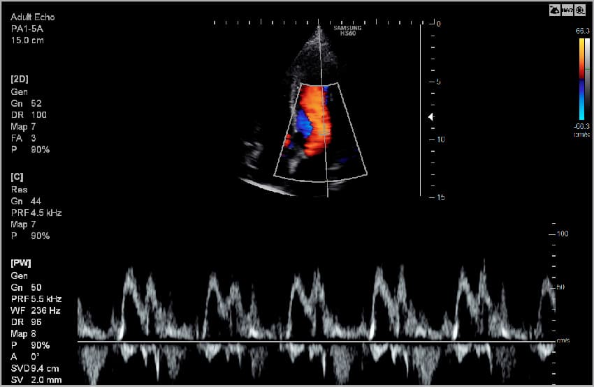 Митрильный клапан – CFM и PW