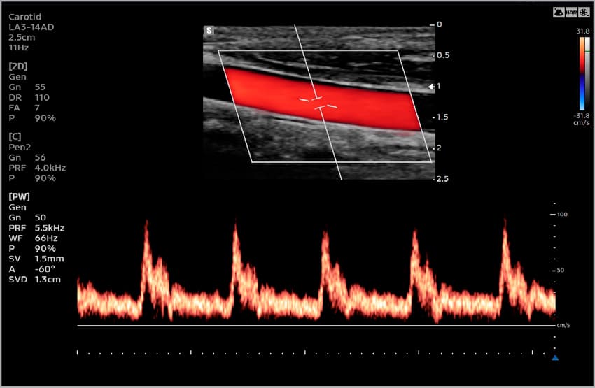 Сонная артерия – CFM и PW