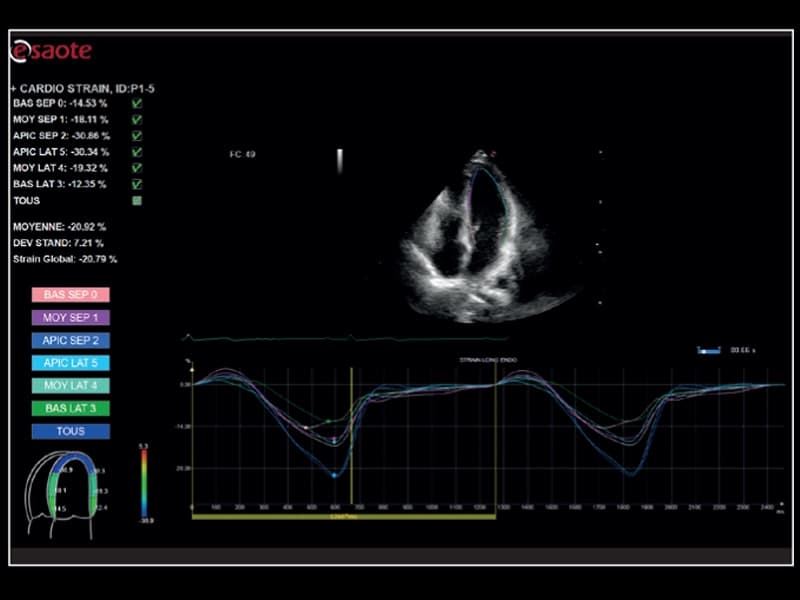 Кардиология – быстрая оценка деформации с помощью XStrain 2D