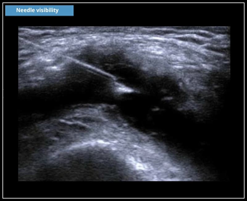 Визуализация иглы