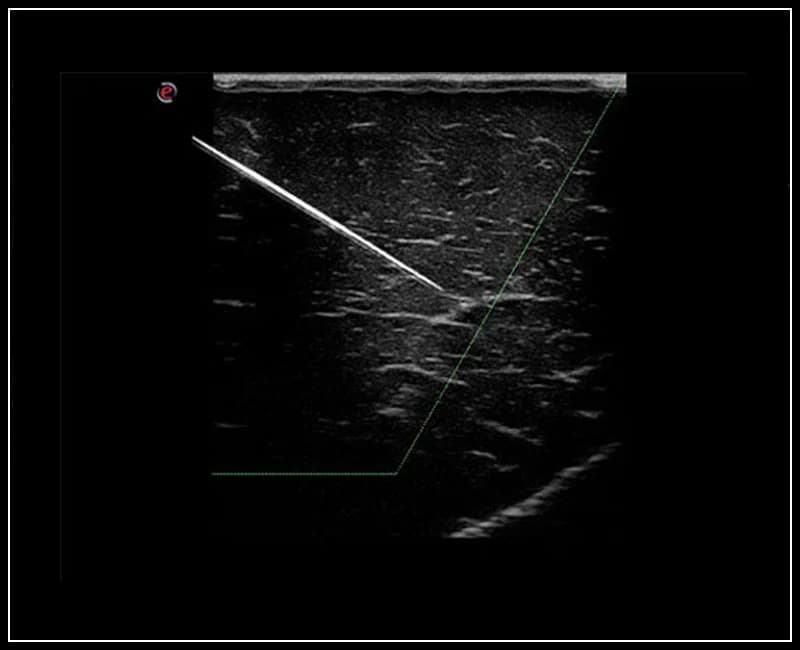 Визуализация иглы