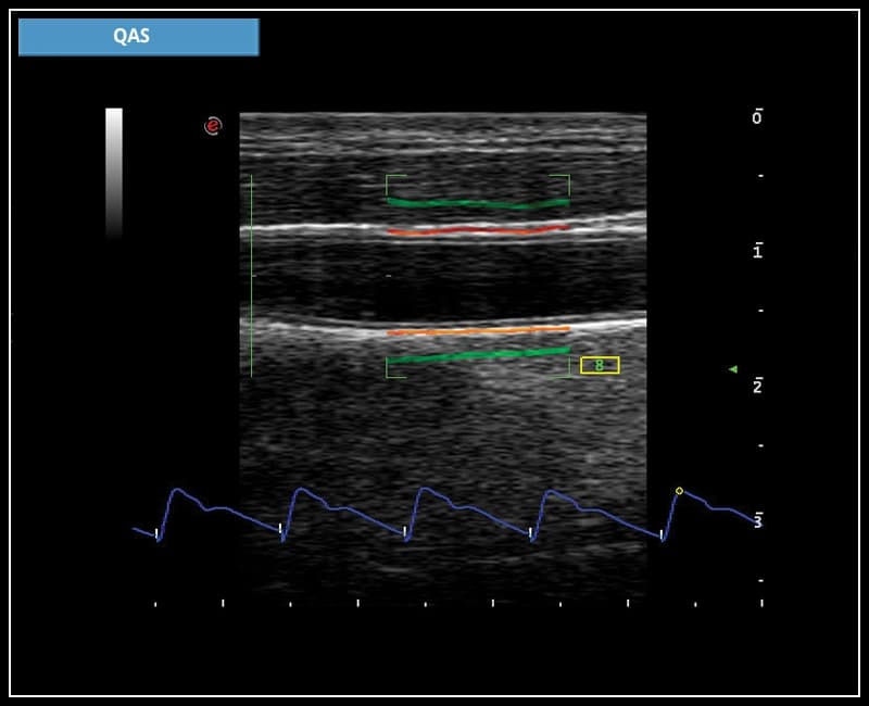 Анализ радиочастотных данных для автоматического измерения прочности стенки сонной артериии – QAS