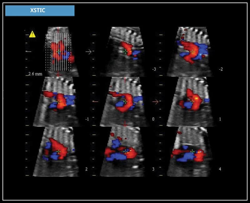 Объемная реконструкция в B-режиме и цветной/энергетической диагностики полостей сердца плода – XStic