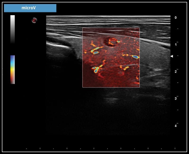 Микроваскуляризация – microV