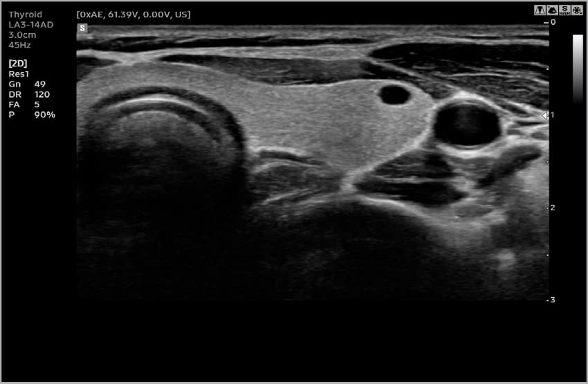 Щитовидная железа – B-режим