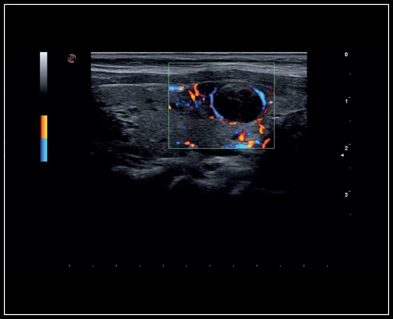 2D with color doppler