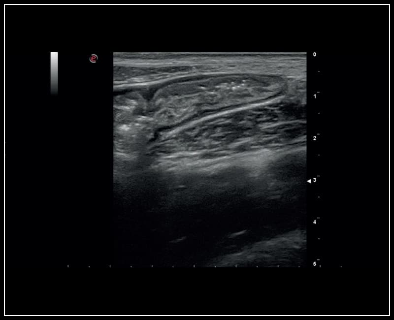 Высокочастотное изображение кишечника – B-режим
