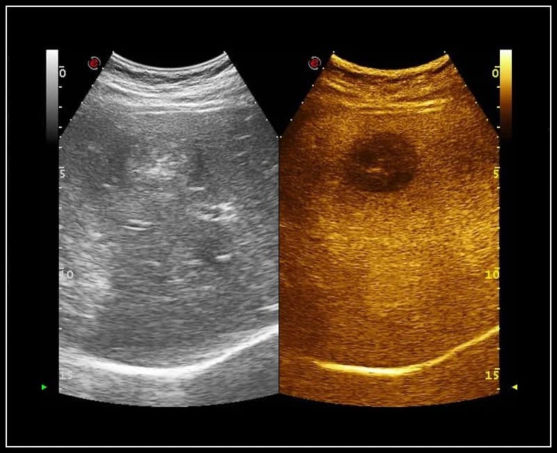 Визуализация с контрастным усилением – CnTI