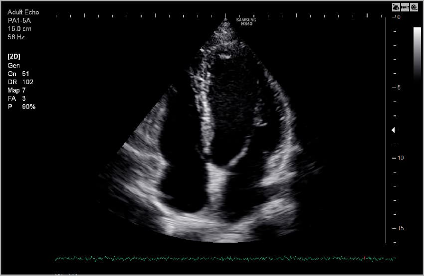 Сердце (4 камеры, апикальный доступ), B-режим
