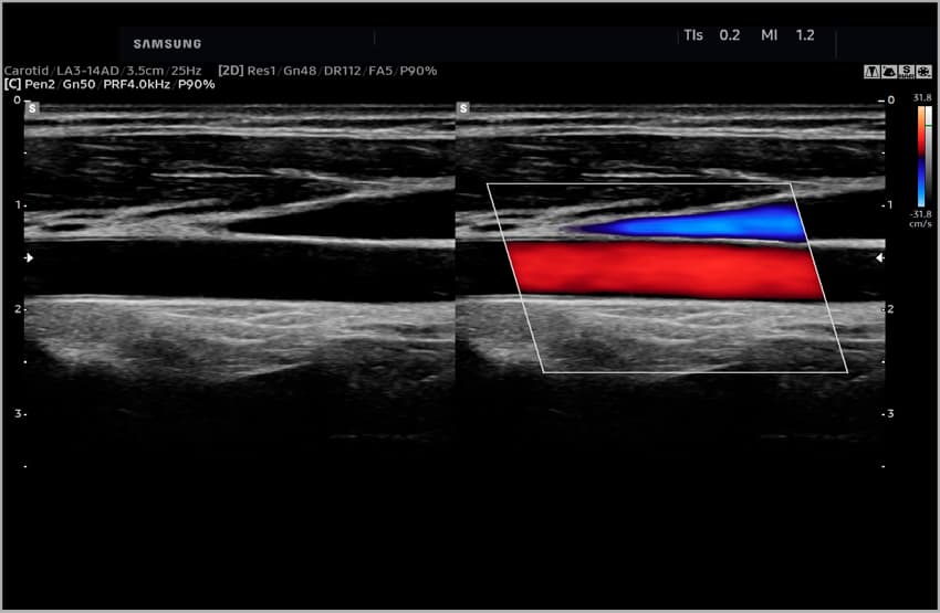 Сонная артерия - цветной доплер