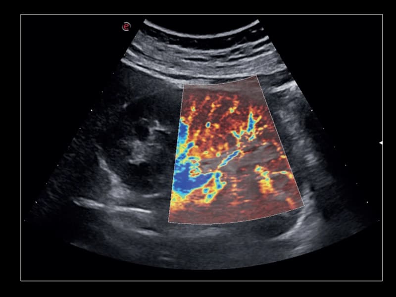 Почки - визуализация тканевой перфузии, microV