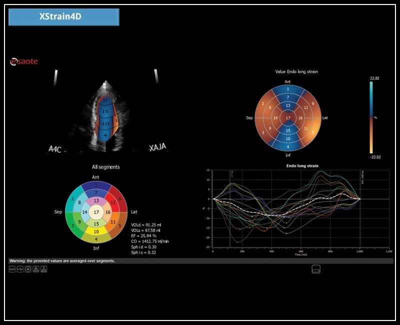 Спекл-трекинг для создания объемной модели функционирования сердца и отчет по анализу глобальной деформации – XStrain4D