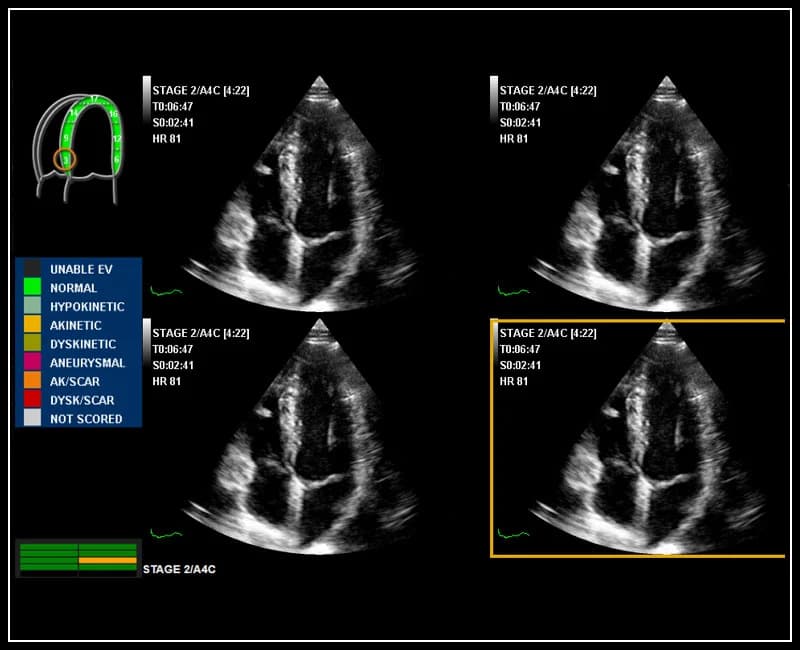 Гибкие и настраиваемые протоколы получения и анализа изображений, работа с контрастными веществами – Stress Echo