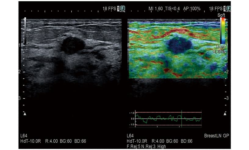 Elastography