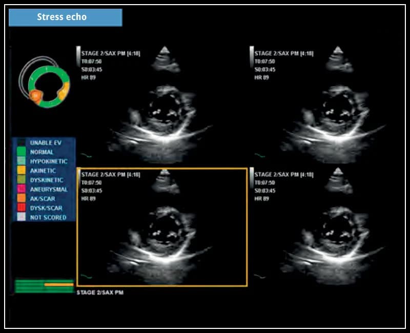 Гибкие и настраиваемые протоколы получения и анализа изображений – Stress Echo