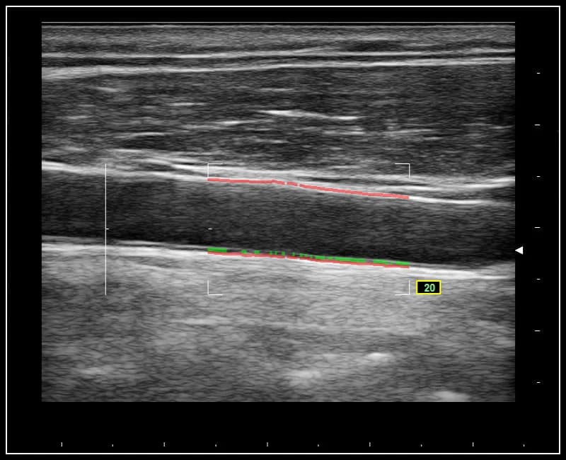 Автоматическое определение толщины интима-медиа – QIMT