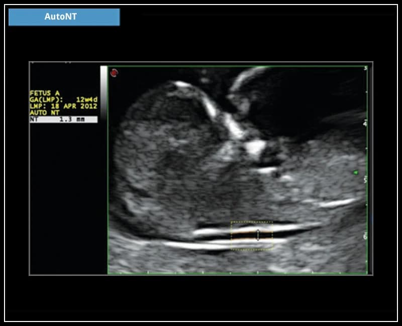 Автоматическое измерение толщины воротниковой зоны плода