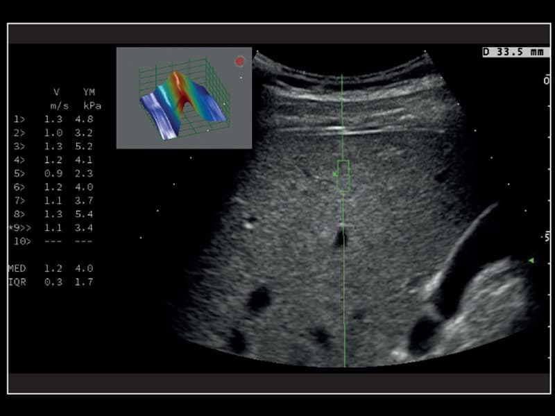 Печень - количественная оценка ригидности, Q-ElaXto
