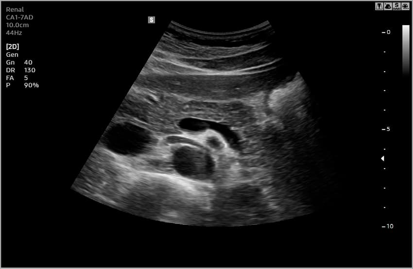 Поджелудочная железа – B-режим 