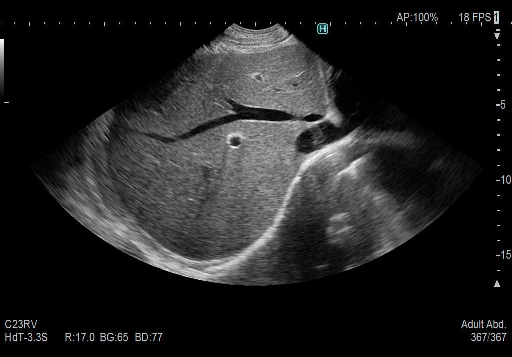Печень. Сканирование с расширенным углом обзора в режиме Wide Scanning
