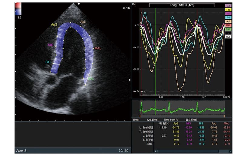 2D Tissue Tracking (2DTT)